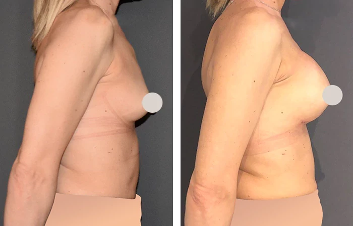 before & after photo of Breast Augmentation