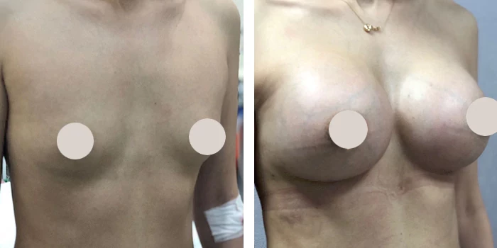 before & after photo of Liposuction