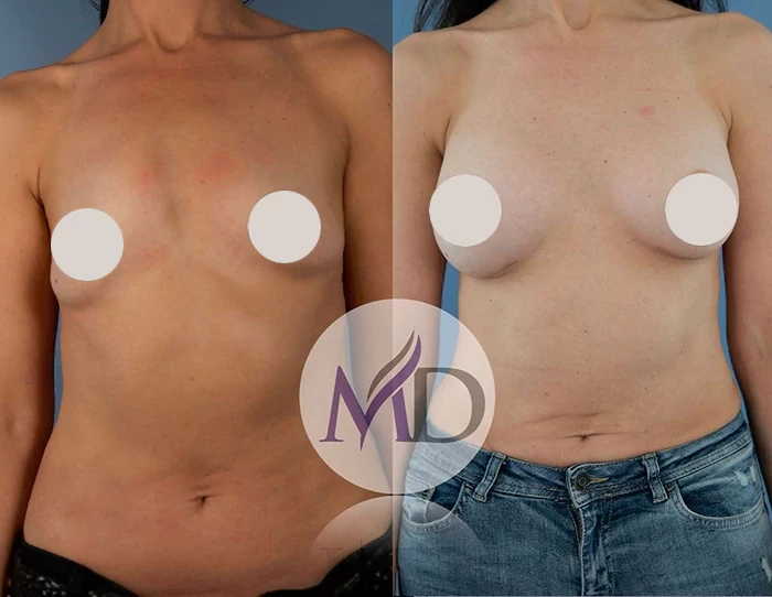 before & after photo of Breast Augmentation