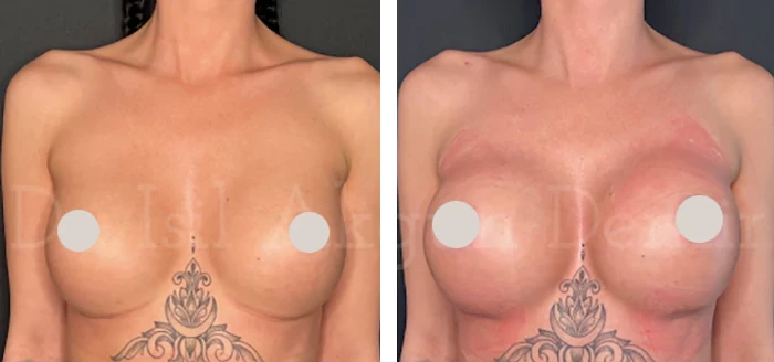 before & after photo of Breast Implants