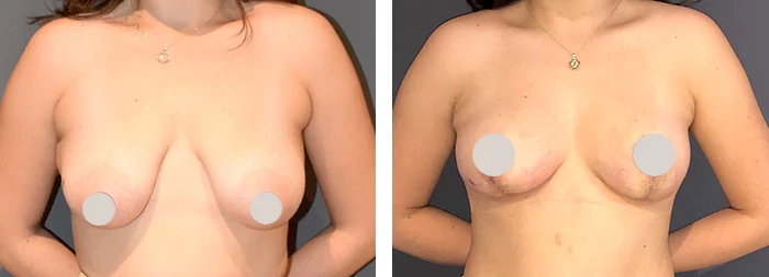 before & after photo of Breast Augmentation