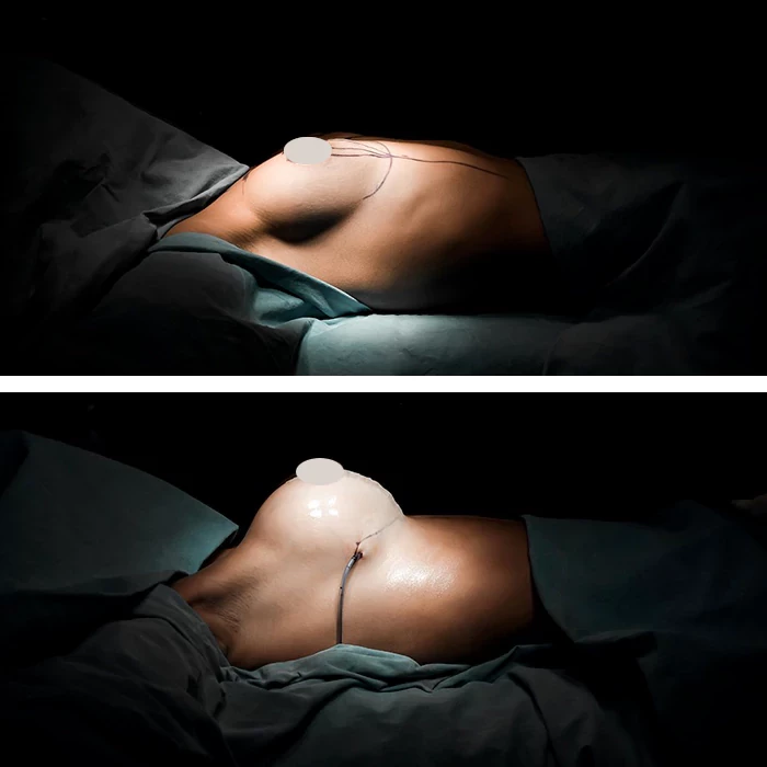 before & after photo of Tummy Tuck