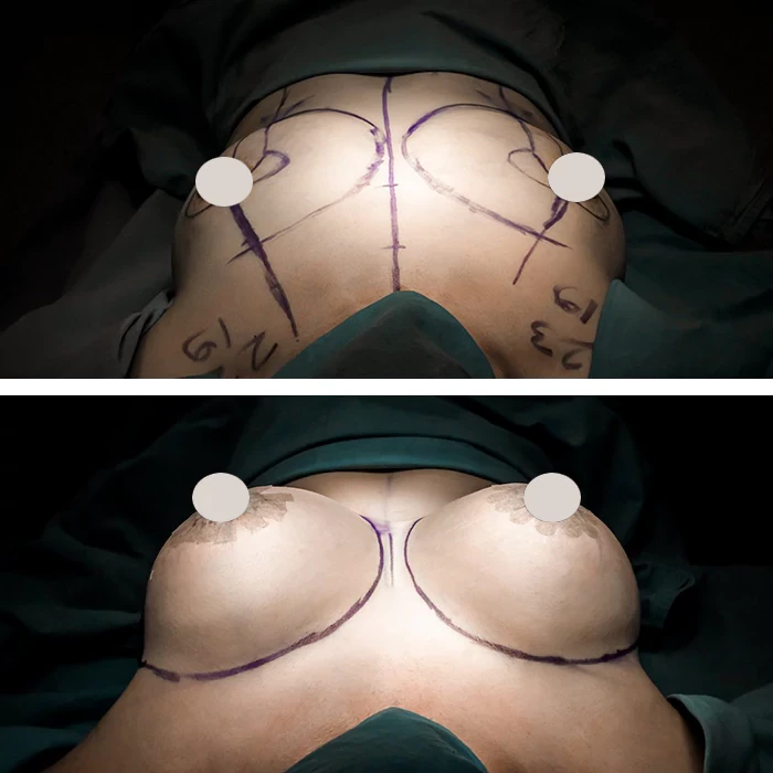 before & after photo of Tummy Tuck