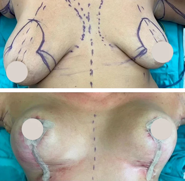 before & after photo of Breast Augmentation