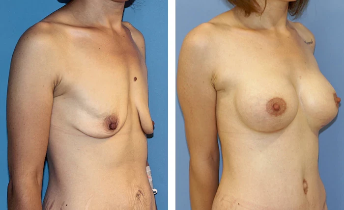 before & after photo of Breast Lift