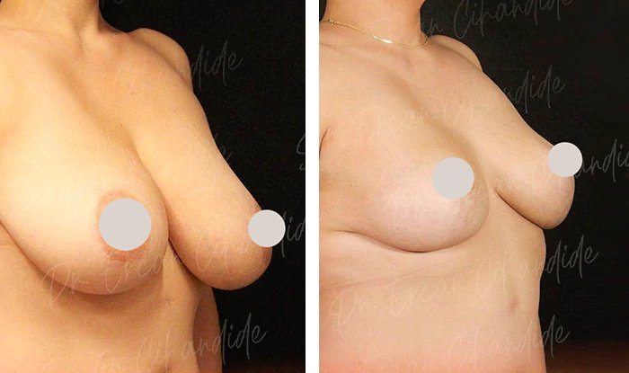 before & after photo of Otoplasty