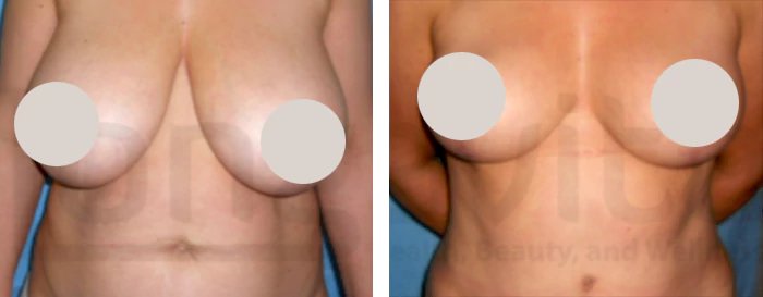 before & after photo of Breast Reduction