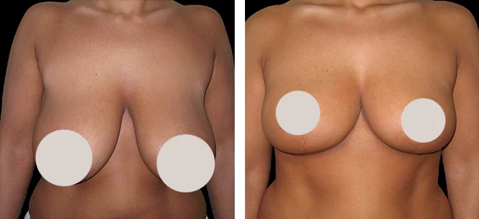 before & after photo of Tummy Tuck