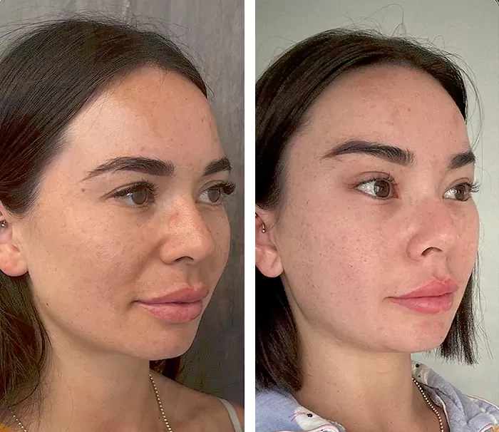 before & after photo of Brow Lift