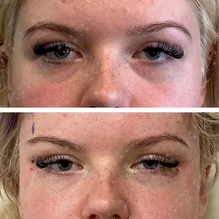 before & after photo of Brow Lift