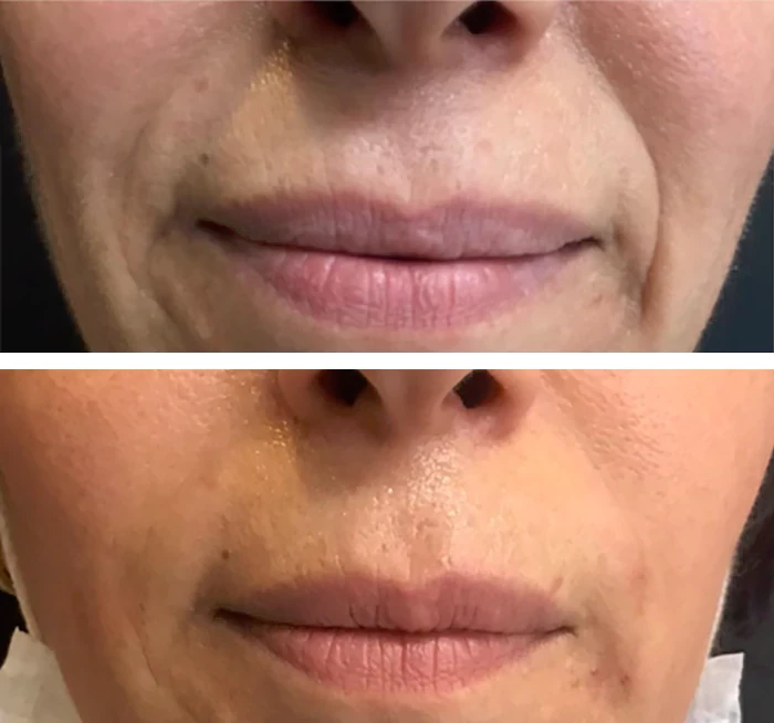 before & after photo of Cheek Filler