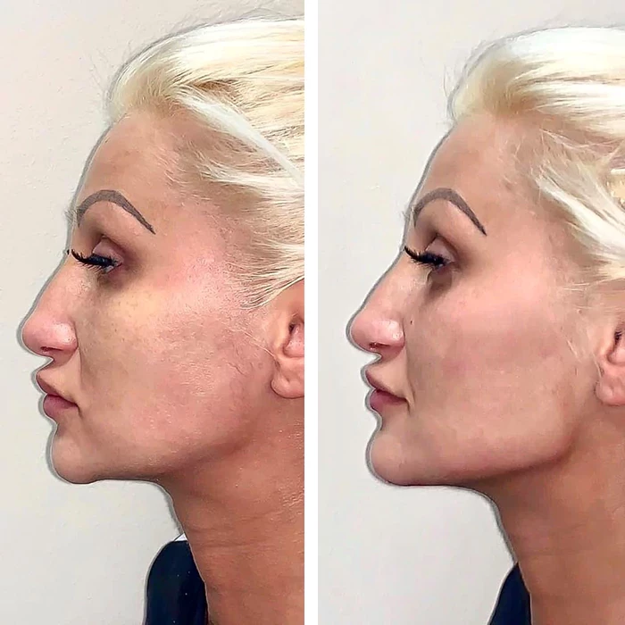 before & after photo of cheek-filler