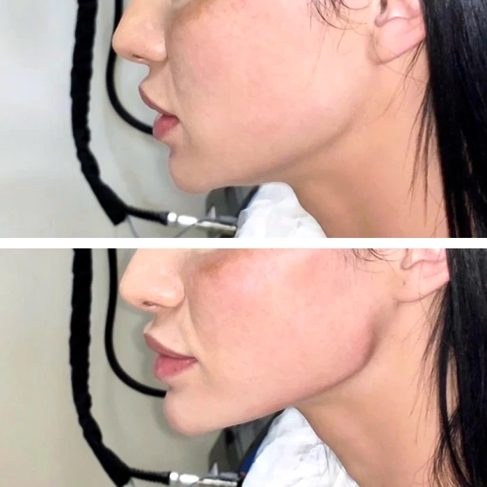 before & after photo of Cheek Filler