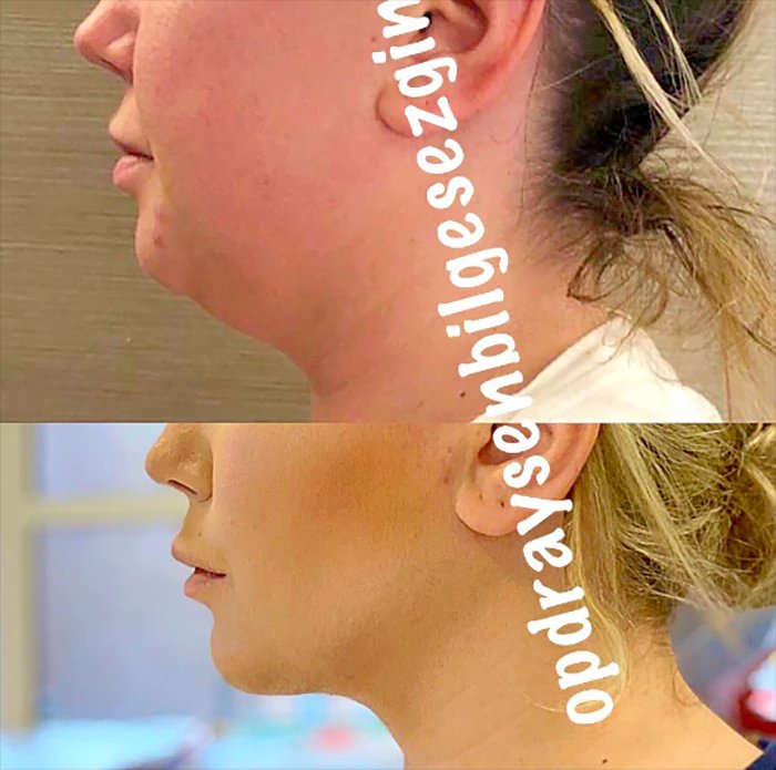 before & after photo of Rhinoplasty