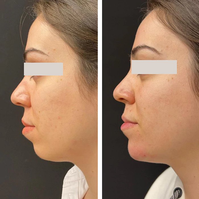 before & after photo of Nose Filler