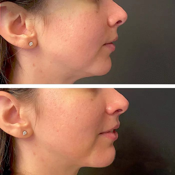 before & after photo of Nose Filler