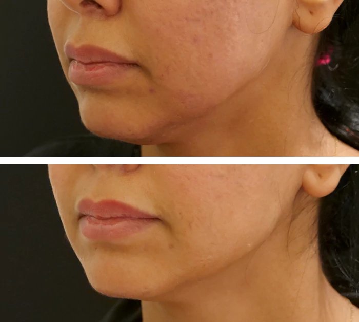 before & after photo of Thread Lift