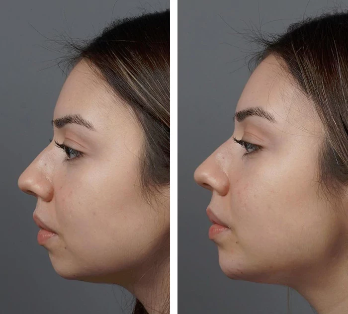 before & after photo of عملية تجميل الأنف