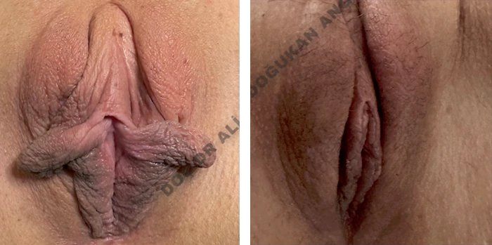 before & after photo of clitoral-hood-reduction