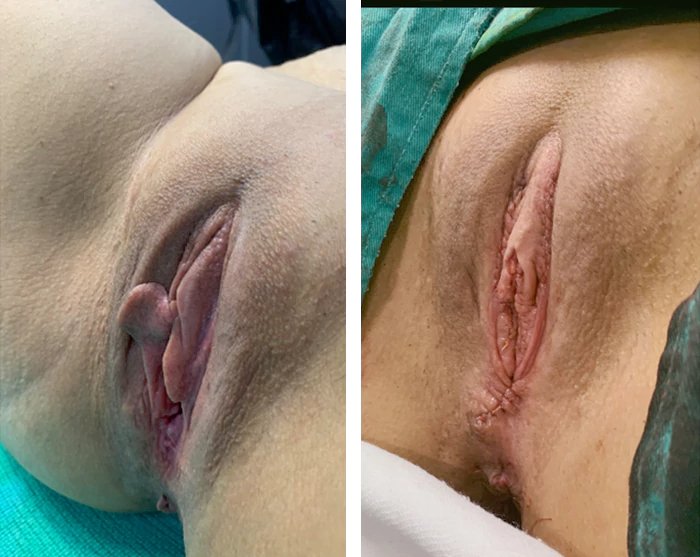 before & after photo of تجميل المهبل