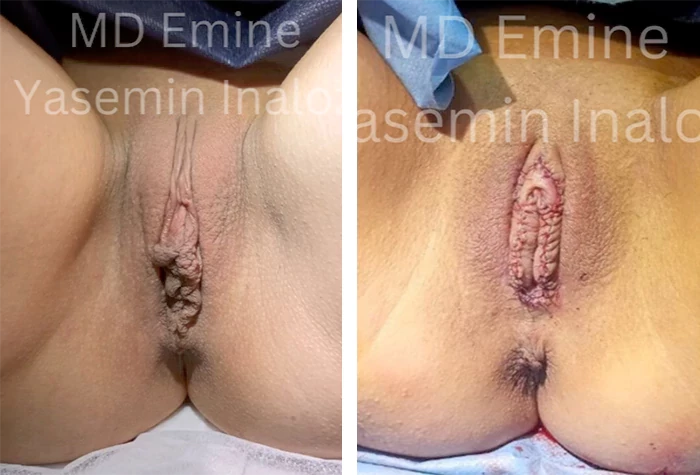 before & after photo of Clitoral Hood Reduction