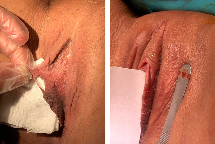 before & after photo of Clitoral Hood Reduction