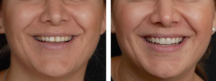 before & after photo of Dental Crown