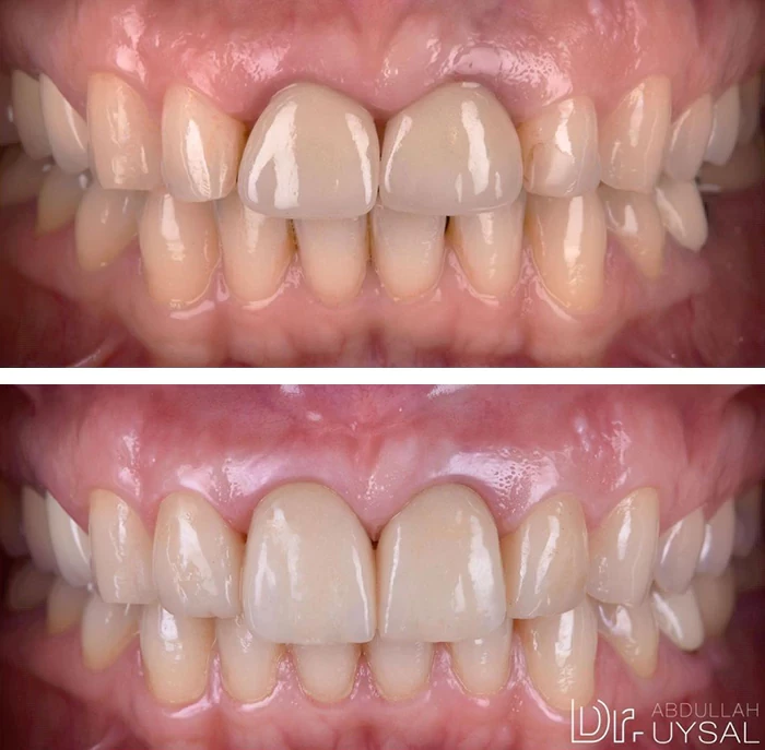 before & after photo of Dental Crown