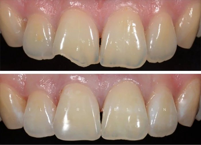 before & after photo of dental-bonding