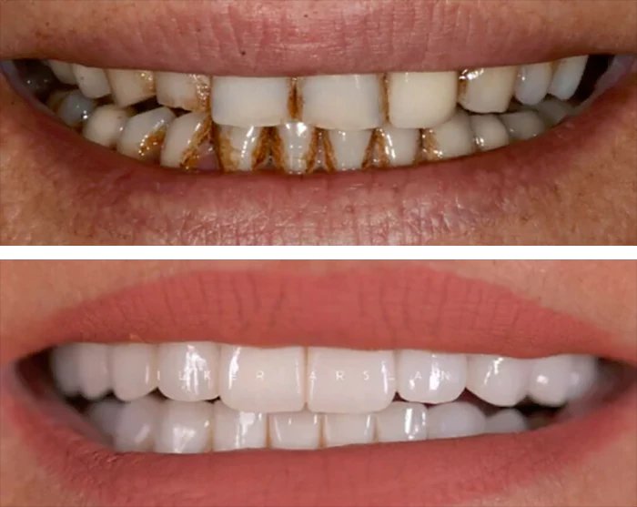 before & after photo of Dental Implant