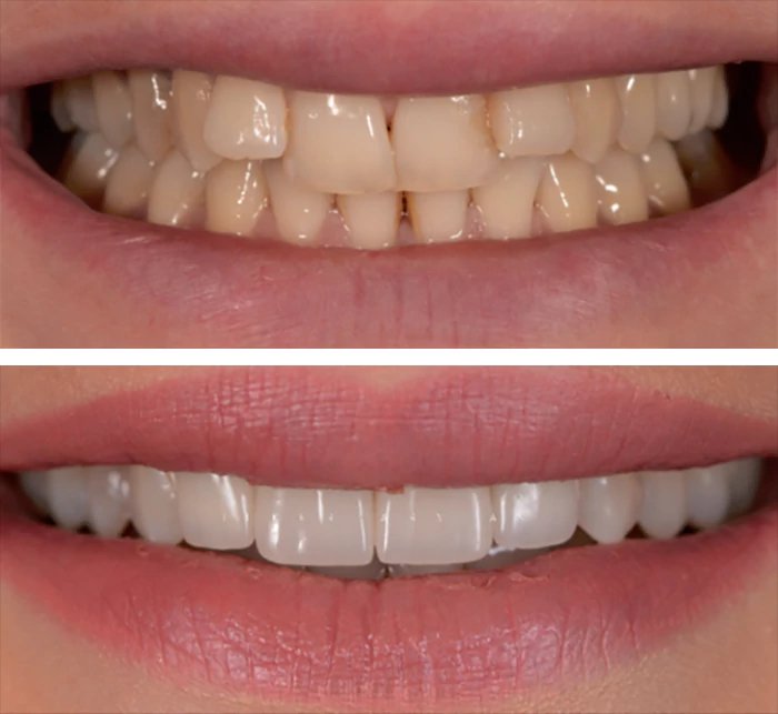 before & after photo of Dental Crown