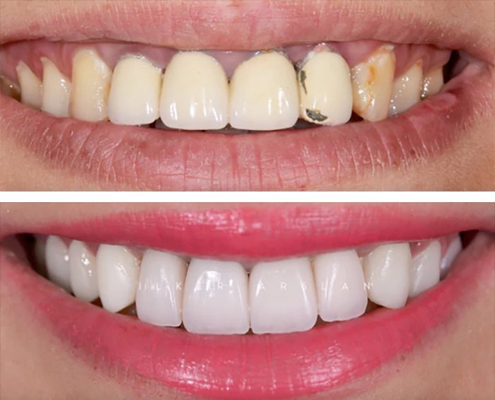 before & after photo of Dental Crown