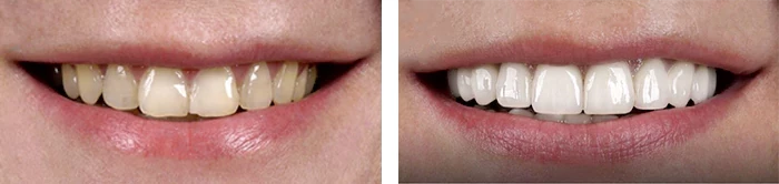 before & after photo of Dental Crown