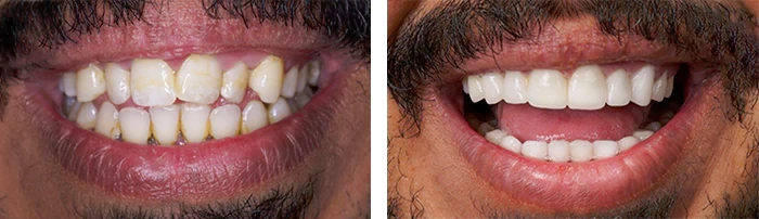 before & after photo of Dental Crown