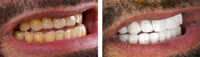 before & after photo of Dental Crown