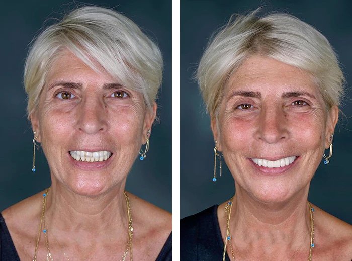 before & after photo of Dental Implant