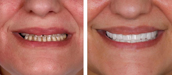 before & after photo of Dental Implant