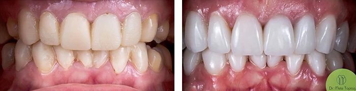 before & after photo of Dental Implant