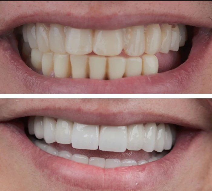 before & after photo of Dental Implant