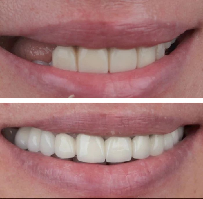 before & after photo of Teeth Whitening