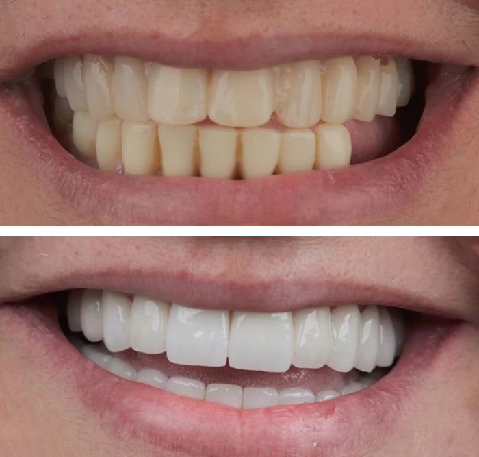 before & after photo of Dental Implant