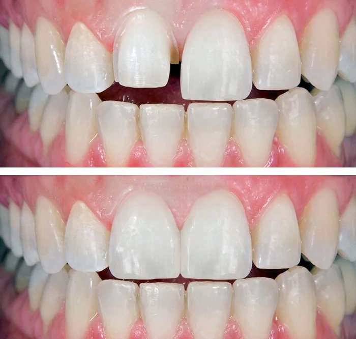 before & after photo of Dental Implant