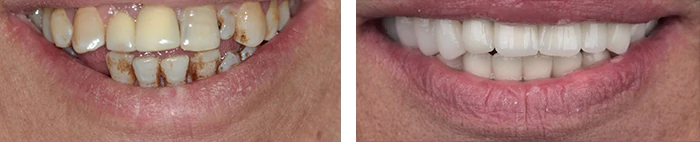 before & after photo of Dental Implant