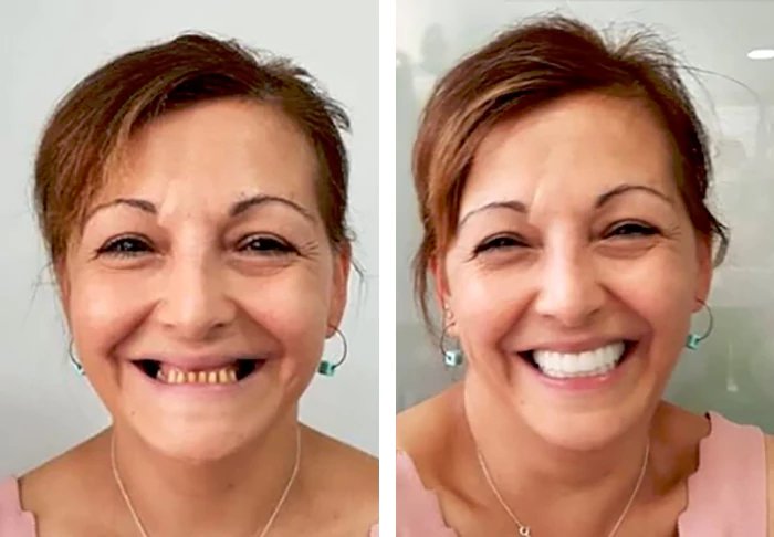 before & after photo of dental-implant