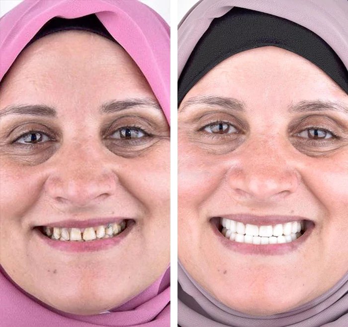 before & after photo of زراعة الأسنان