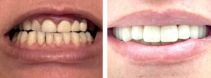 before & after photo of Dental Implant