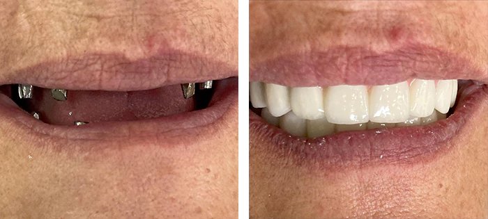 before & after photo of Dental Implant