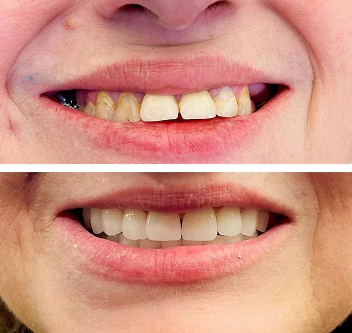 before & after photo of Dental Implant