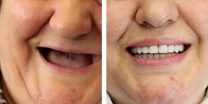 before & after photo of Dental Implant