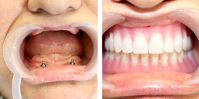 before & after photo of Dental Implant